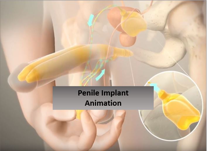  Learn more about how the 3-piece penile implant works