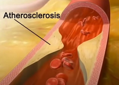 ED and Heart Disease